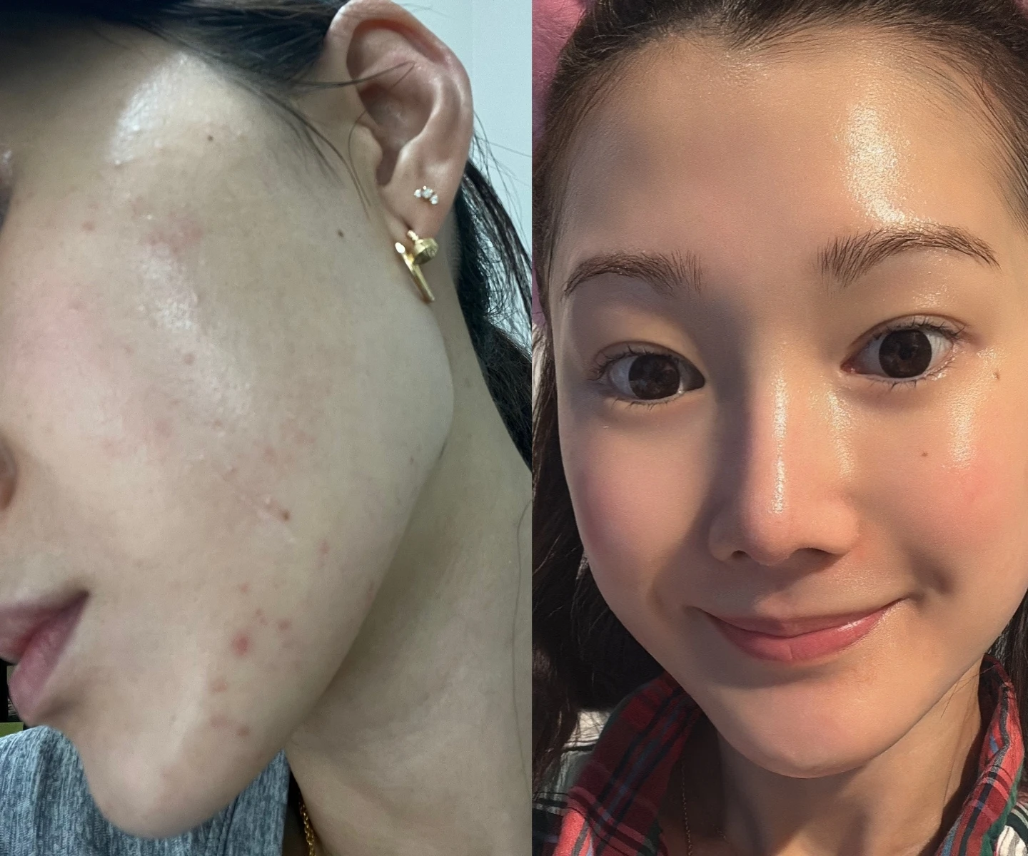 I Had My First Adult Acne Flare at 29: 5 Products That Saved My Skin