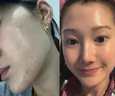 Beauty IQ Article - I Had My First Adult Acne Flare at 29: 5 Products That Saved My Skin