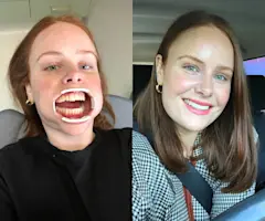 Every Single Question I Asked Before Getting Veneers to Improve My Chipped Teeth
