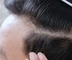 Everything You’ve Always Wanted to Know About Dandruff