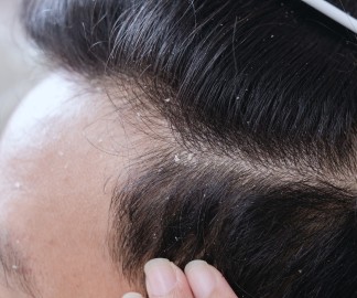 What Causes Dandruff & How to Treat It_A close up of dark hair and scalp with dandruff