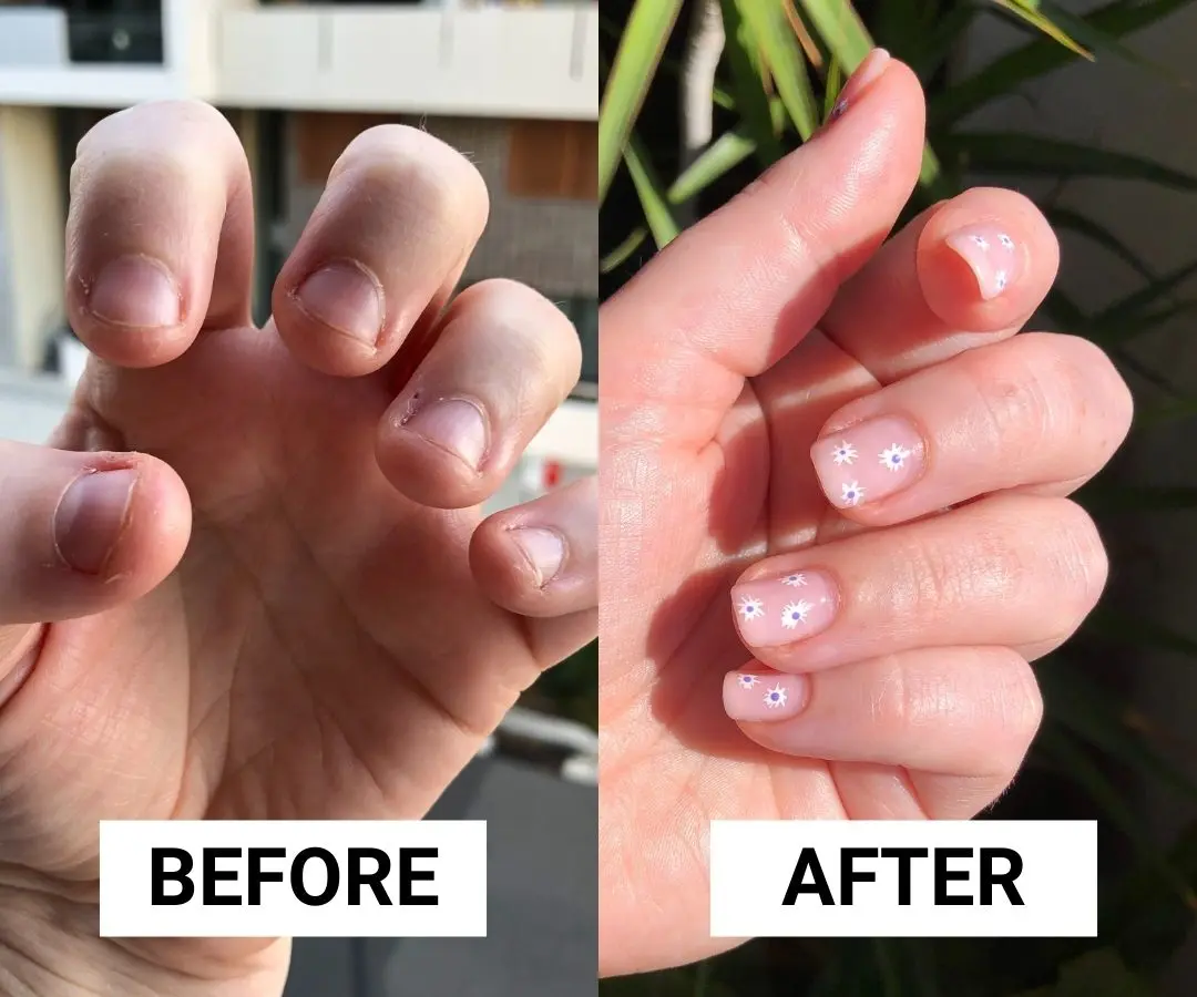 How to Stop Nail Biting: After 20 Years, This Is How I Finally Broke My Biting Habit
