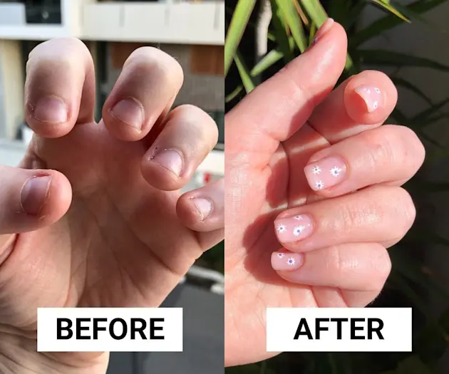 How to Stop Nail Biting: After 20 Years, This Is How I Finally Broke My Biting Habit