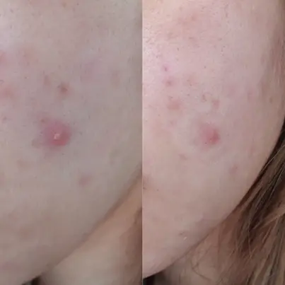 Beauty IQ Article - do-pimple-patches-really-work