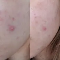 Do Pimple Patches Really Work?