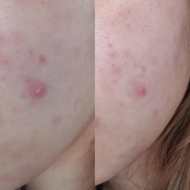 Do Pimple Patches Really Work?