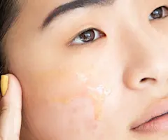A Dermal Therapist Answers Your Post-Inflammatory Hyperpigmentation (Acne Scar) Questions
