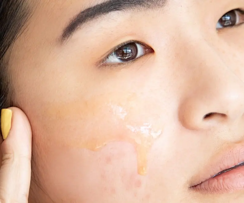A Dermal Therapist Answers Your Post-Inflammatory Hyperpigmentation (Acne Scar) Questions