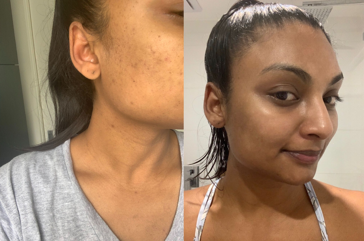 How to Treat Hormonal Acne Breakouts with a Night Skincare Routine