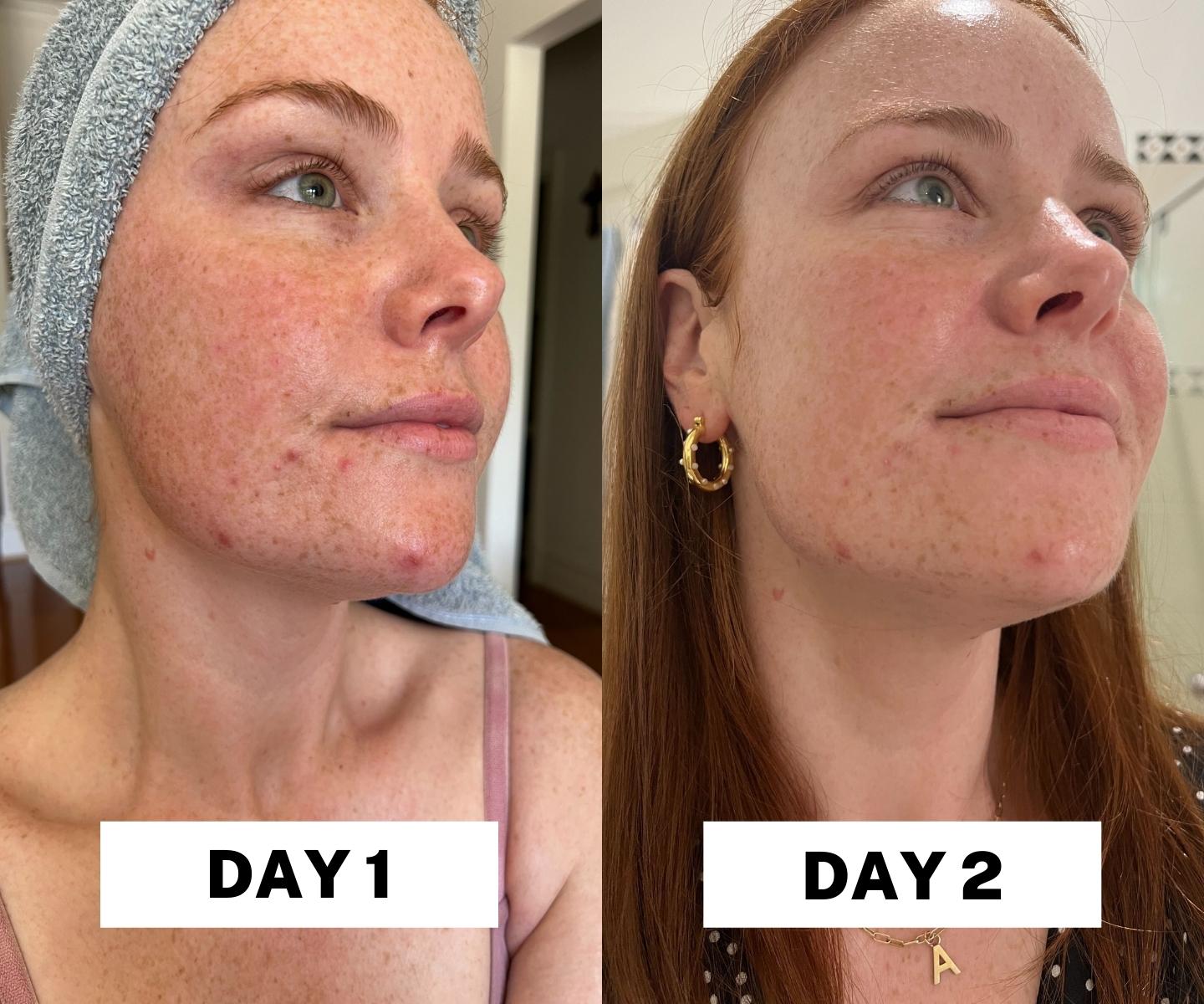 The Ordinary Salicylic Acid Before and After.