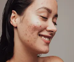 Skin Purging vs Breakouts: How to Tell the Difference (& When to Throw in the Towel)
