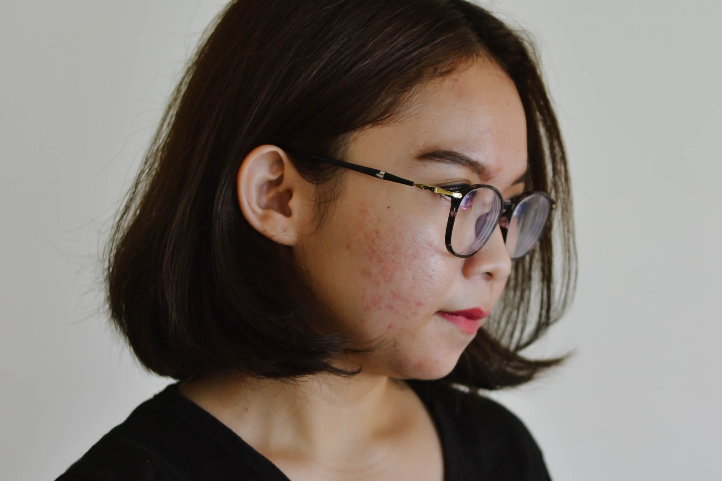 audrey-jackson-unsplash-woman with short bob hair is wearing glasses and looking to the side. Her cheek has small red blemishes. 1200 x 800