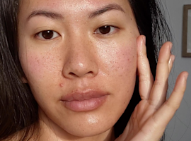 How to Get Rid of Red Acne Scars