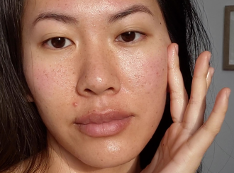 how-to-get-rid-of-red-acne-scars_woman with red acne scar and some pigmentation touching side of her face with her fingertips_1080x800