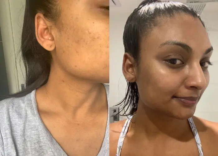 How to Treat Hormonal Acne Breakouts with a Night Skincare Routine