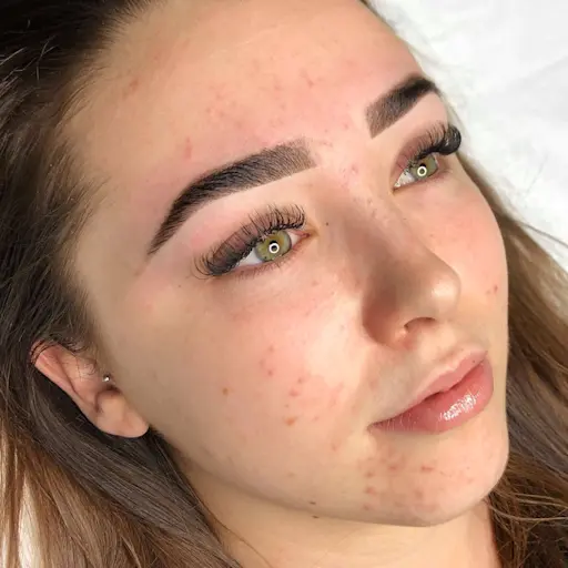 Morning Routine for Hormonal Acne