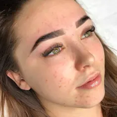 Morning Routine for Hormonal Acne