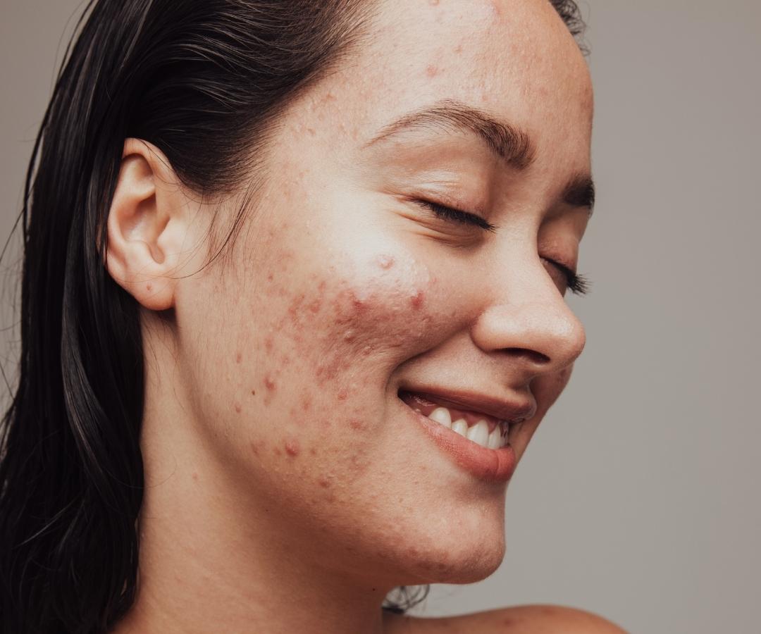 The Only Way to Manage Hormonal Acne as an Adult, According to an Expert picture