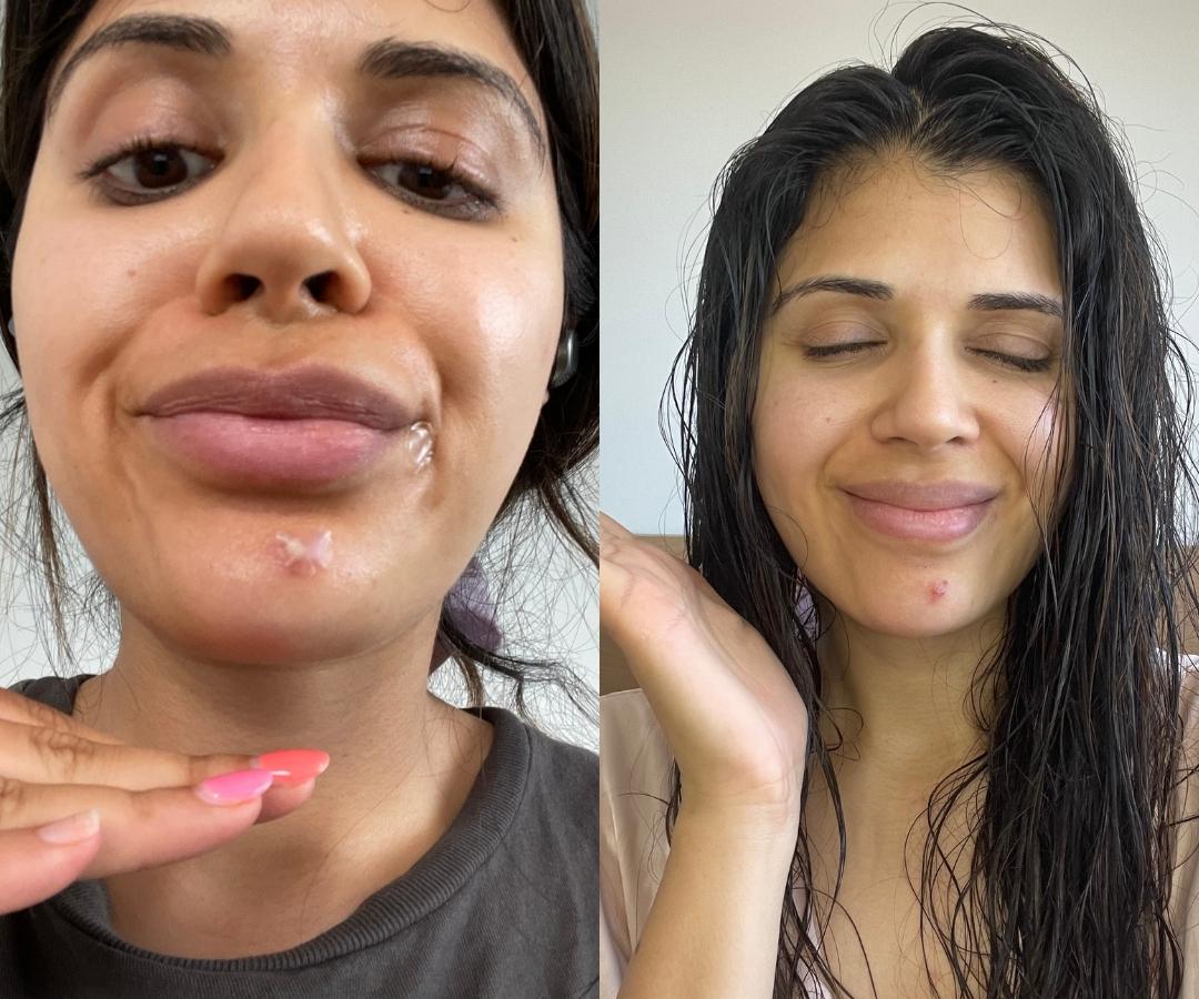 pimple patch before and after