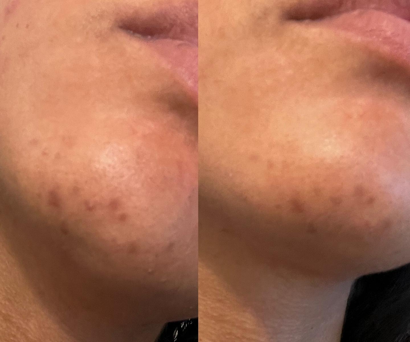 murad rapid dark spot correcting serum before and after skin 
