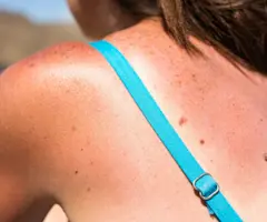 So, You Accidentally Got Sunburnt... Here's What to Do Next