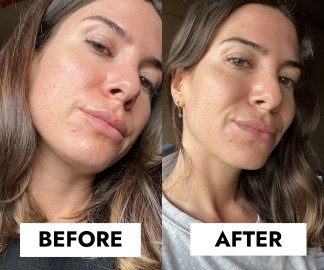 cerave blemish control review before and after pictures