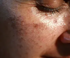 Can You Get Rid Of Sun Damage for Good? We Answer All Your Hyperpigmentation Questions