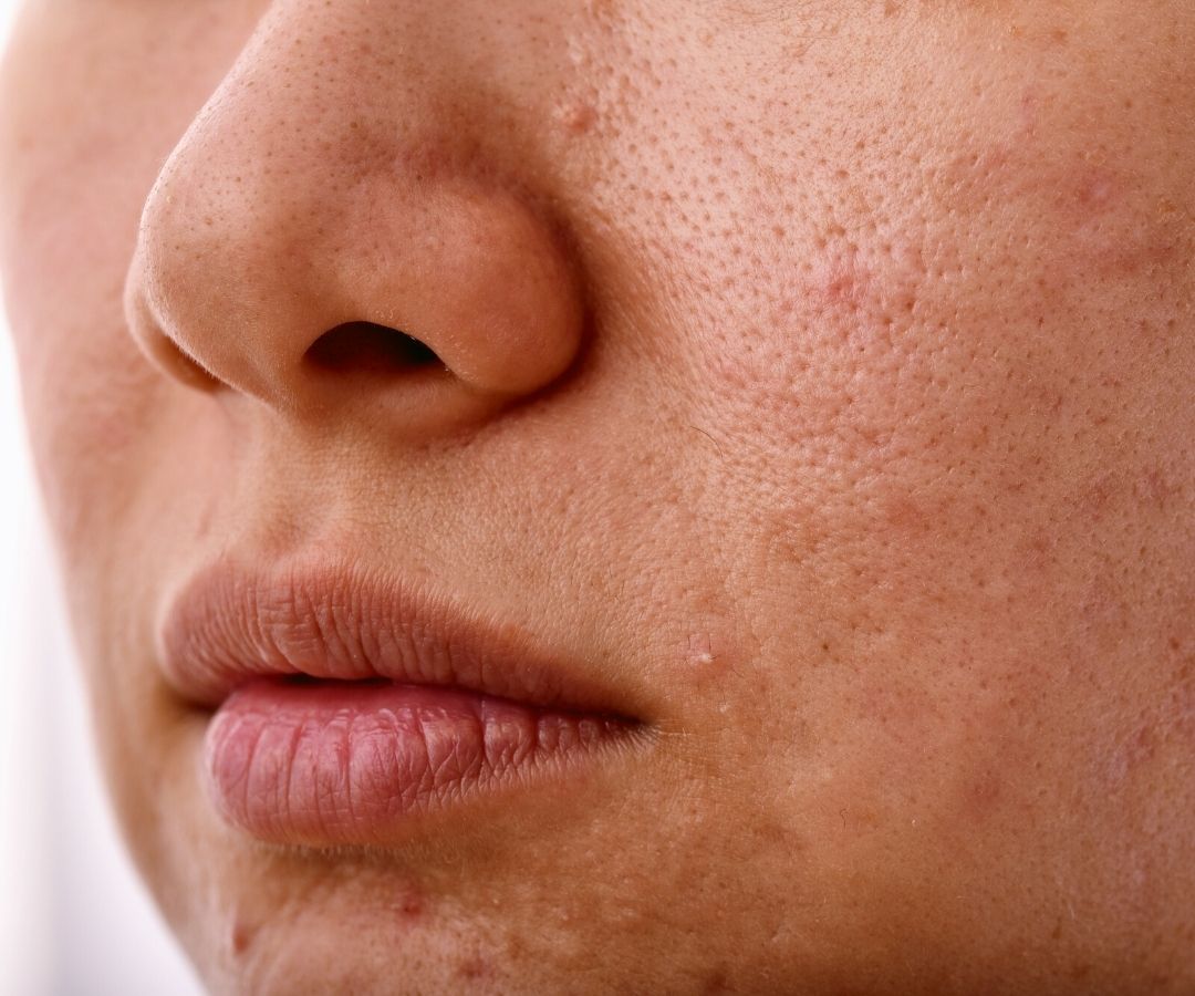 Blackheads or Sebaceous Filaments