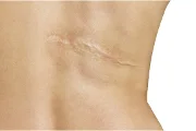Can I Use Scar Cream Before My Skin Has Healed?
