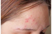 How Should I Exfoliate Acne-Prone Skin?