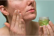How Can I Prevent Healing Skin From Scarring?