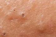 What Is a Blackhead?