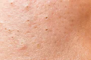 Three Tips to Get Rid of Blackheads