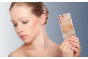 What's the Best Way to Cover Eczema on the Face?