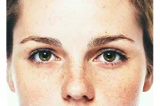 What Treatments are Effective for Hyperpigmentation?