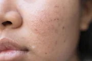 I'm Not a Teen, So Why Do I Have Acne?