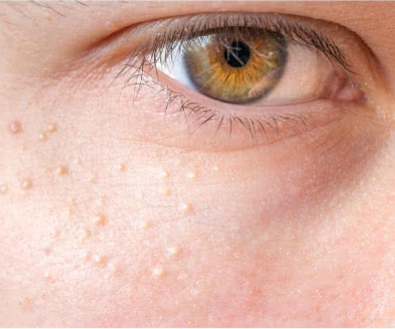 Can Eye Creams Cause Milia? Here Are All Your Burning Questions, Answered