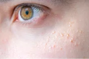 Can Eye Creams Cause Milia?