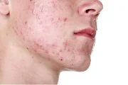 How Do I Reduce the Redness of Acne Scars?