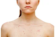 Should I Skip Makeup When I Have a Breakout?