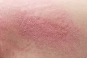 Do I Have Sensitive Skin?