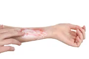 How Do Scars Form, and Can I Prevent Scars?