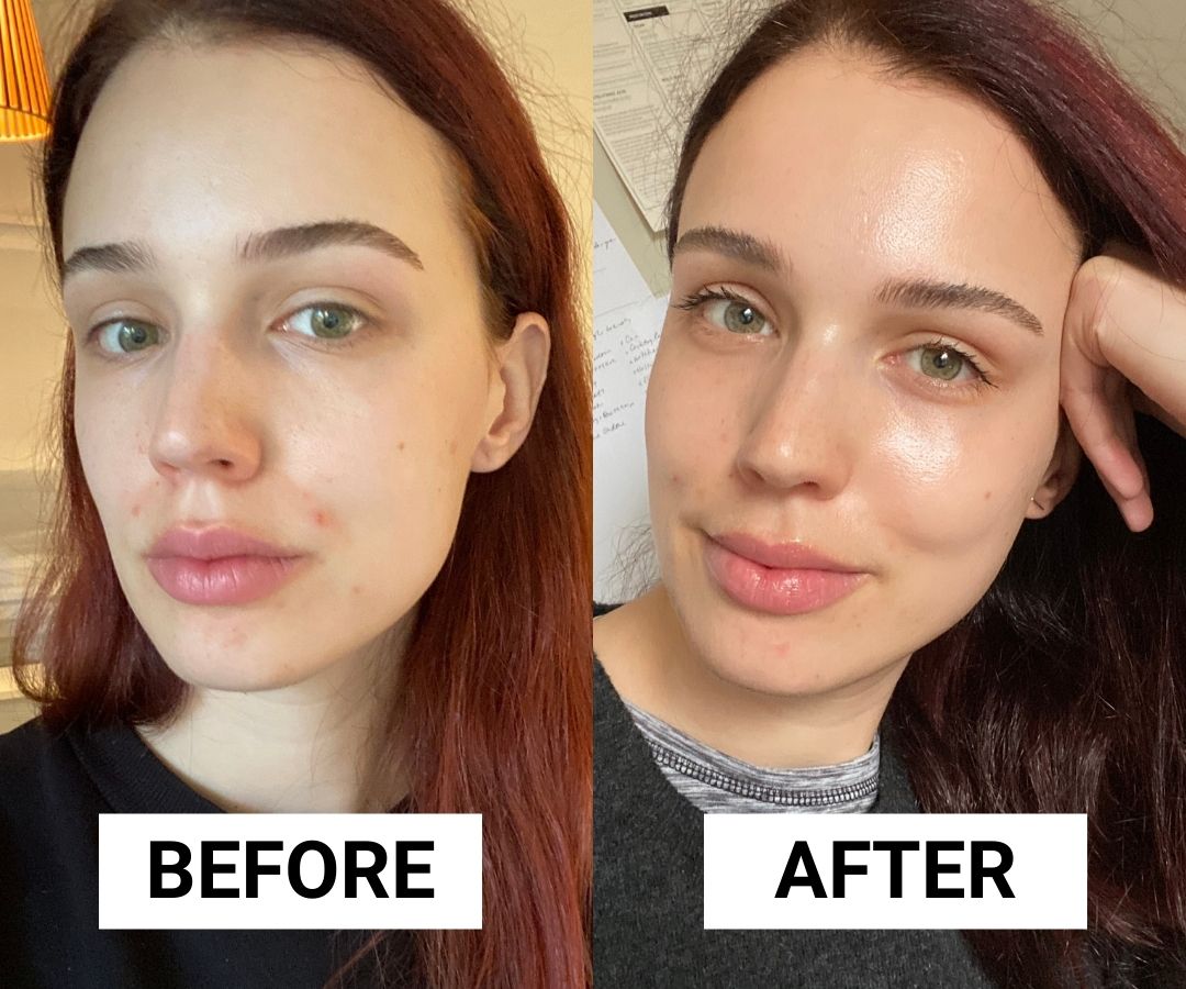 This Cleanser and Duo Healed Breakouts in a Week