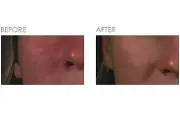 Beauty IQ Article - Is There A Clarisonic for Sensitive Skin?