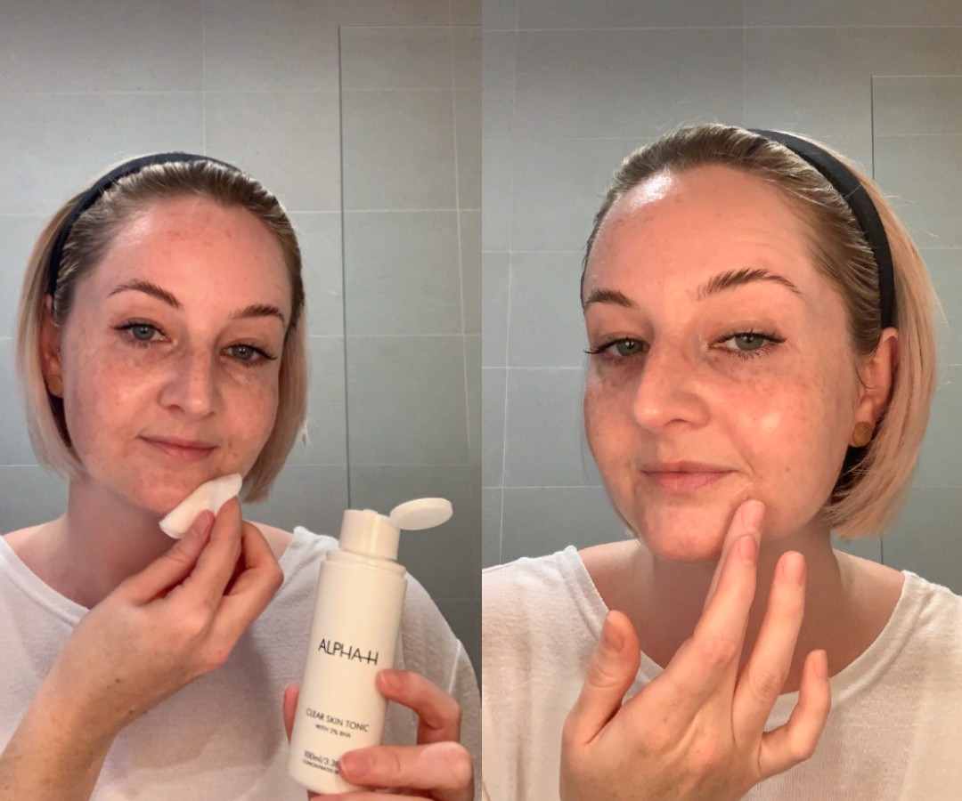 How To Treat Acne Prone Skin Using Alpha H Skin Care Products
