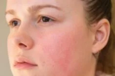 How to Care for Redness and Rosacea - Your Questions Answered