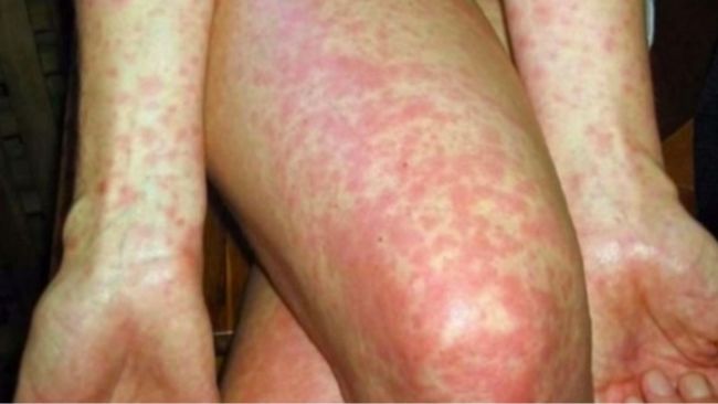 Scarlet fever outbreak in Scotland: what you need to know