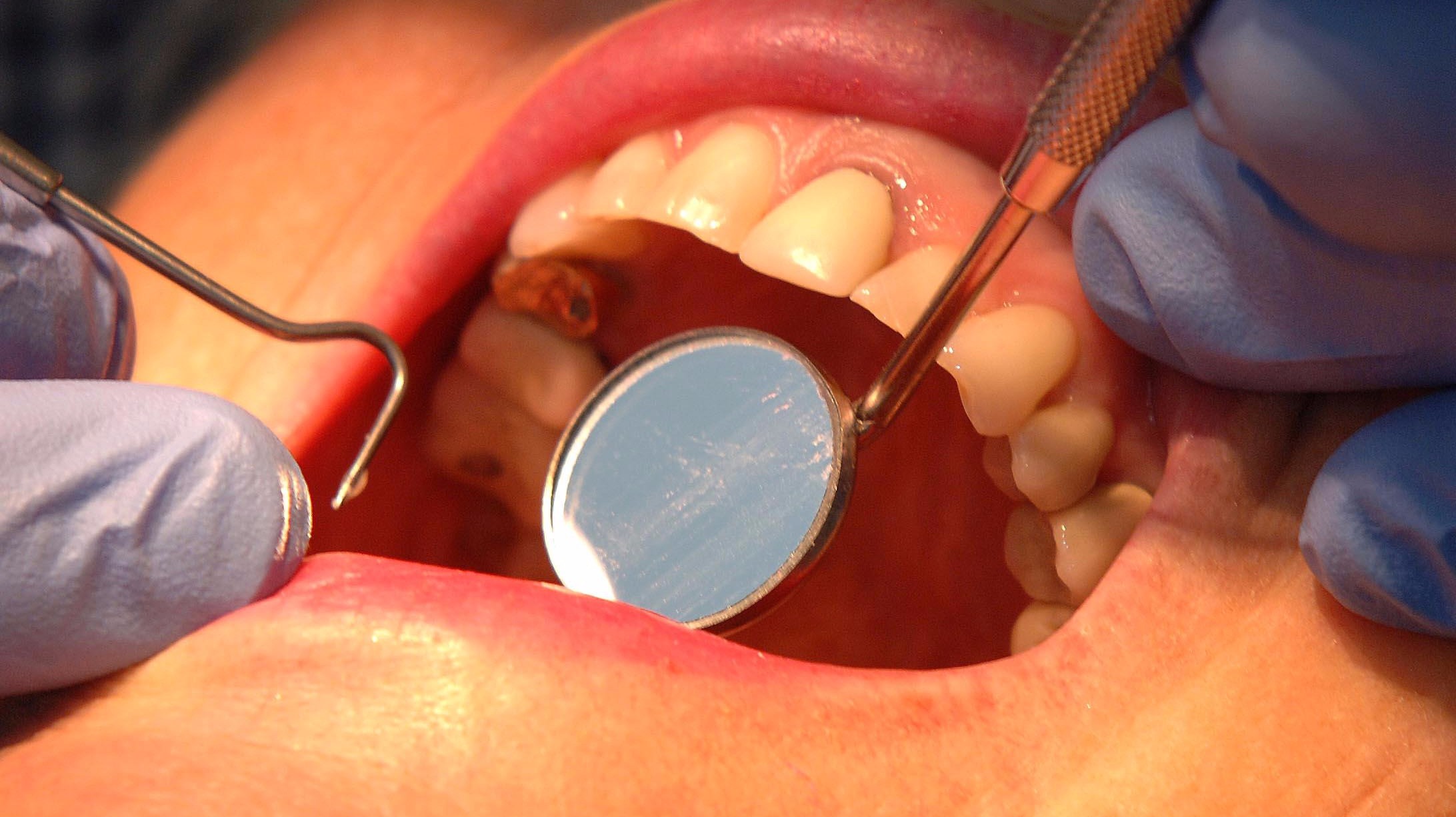 Nearly 1 In 3 Children Have Tooth Decay In Bristol ITV News West Country