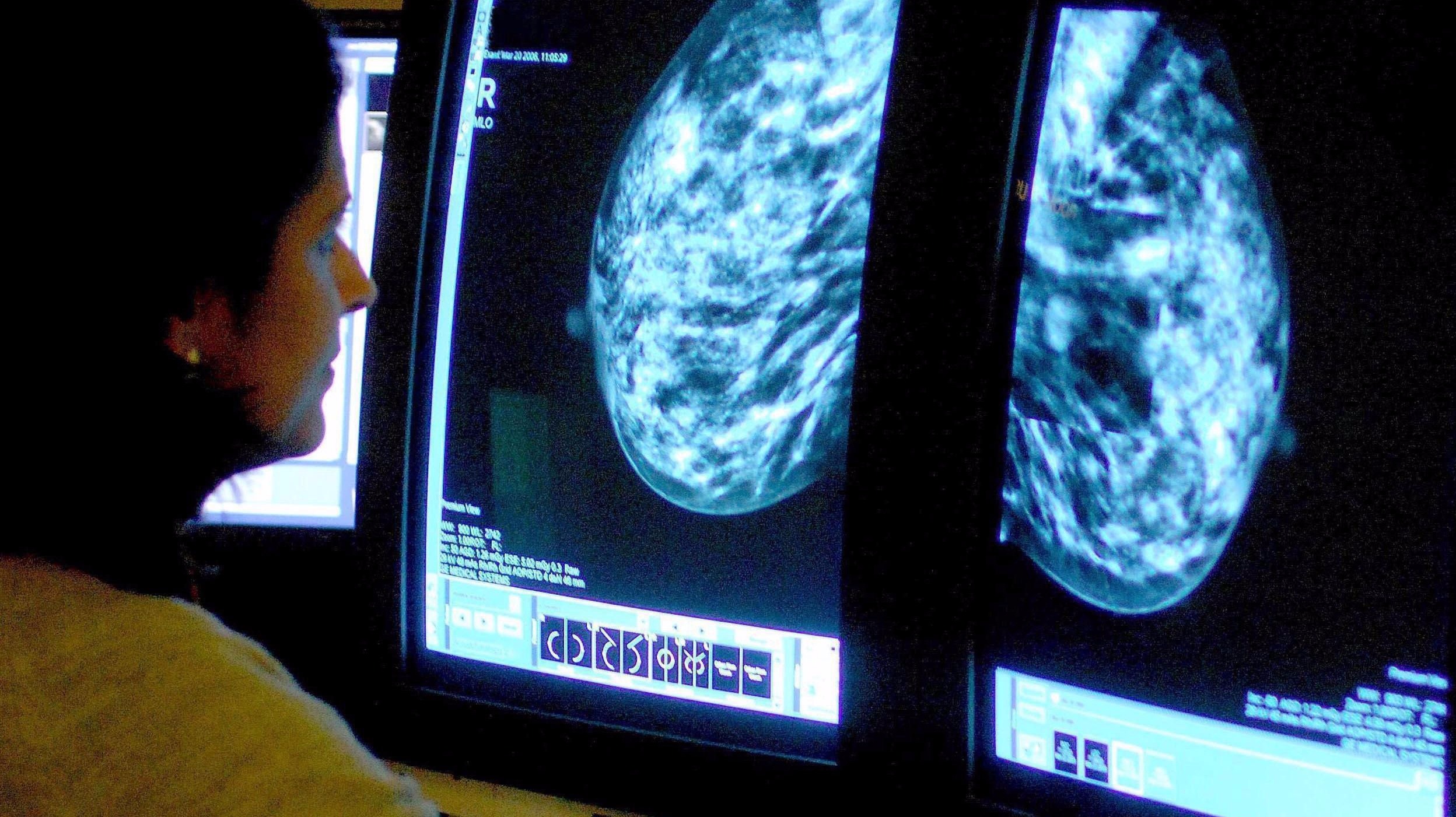 breast-cancer-patients-should-stay-on-drugs-for-a-decade-says-research