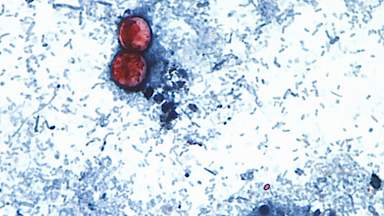 Two deaths linked to 'explosive diarrhoea' outbreak in US, officials say